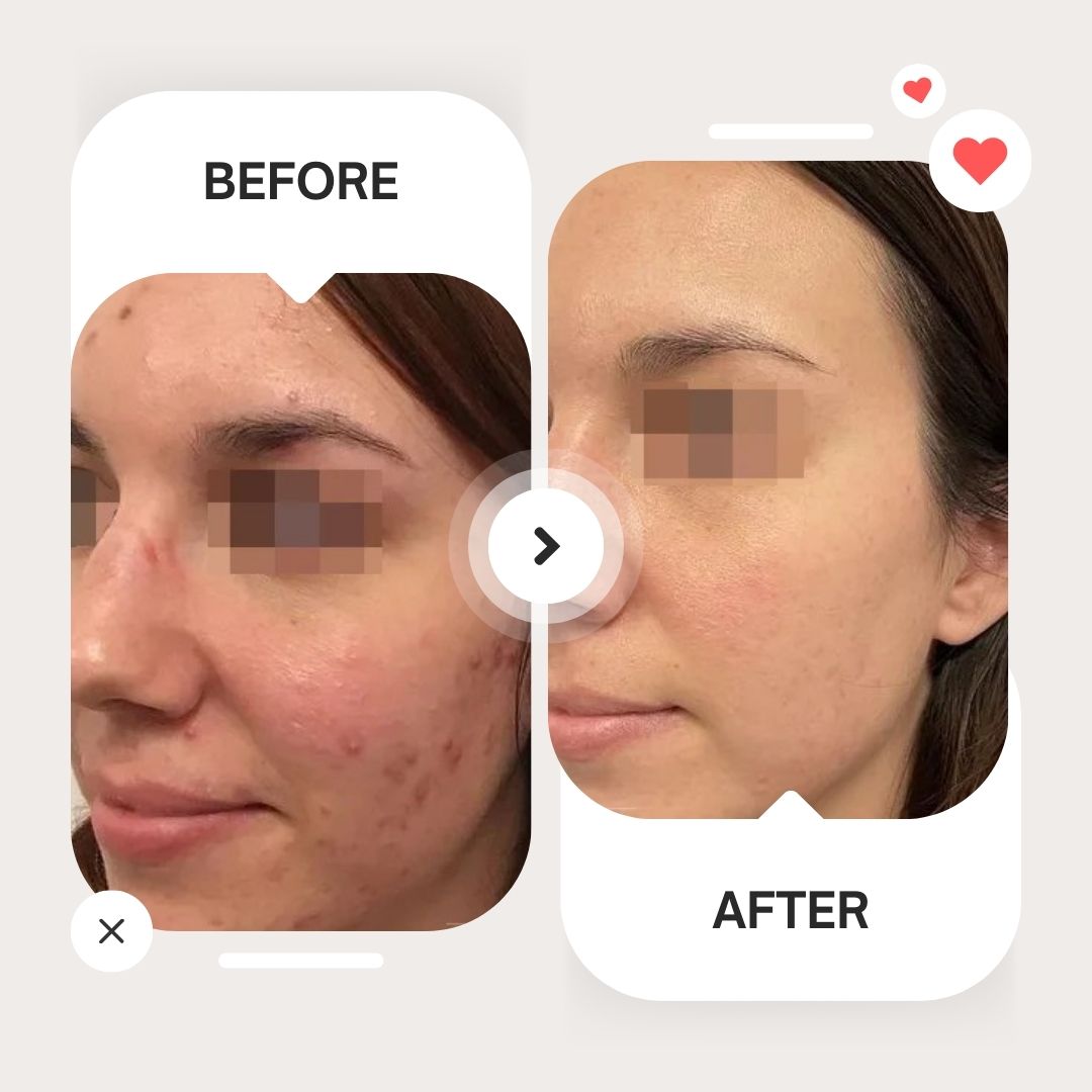 Before and after a Hydrafacial treatment at ZEN Healthcare Dubai